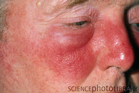 bacterial rash on face #11